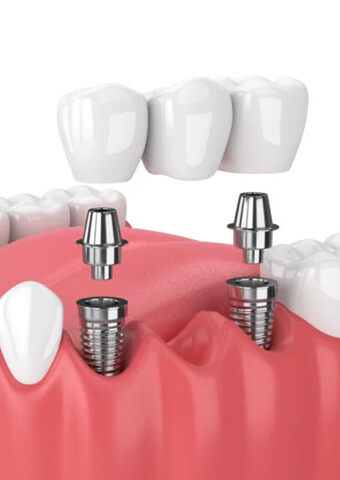 How Many Dental Implants do you need 