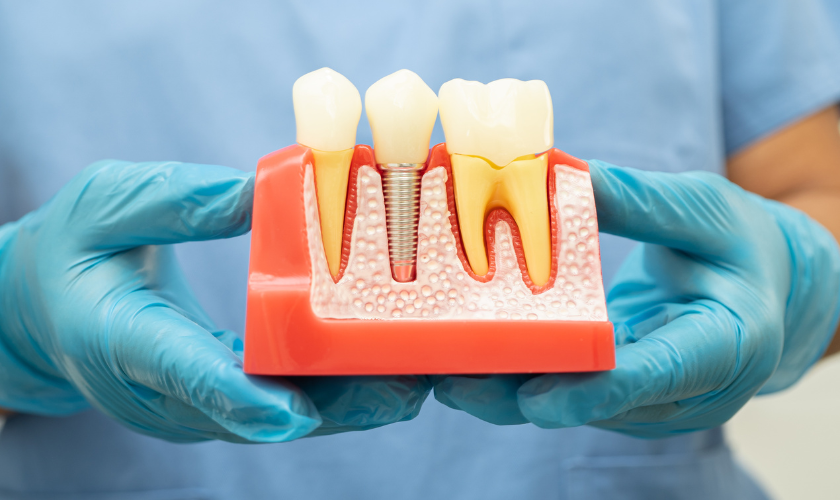 Unlocking the Mystery- Understanding Dental Implants and Their Suitability