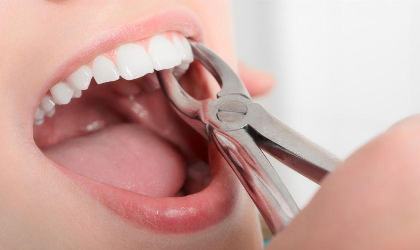 Preparing for Wisdom Teeth Removal- What to Expect
