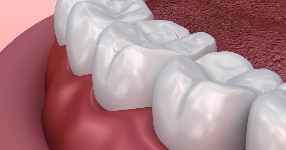 The power of dental sealants
