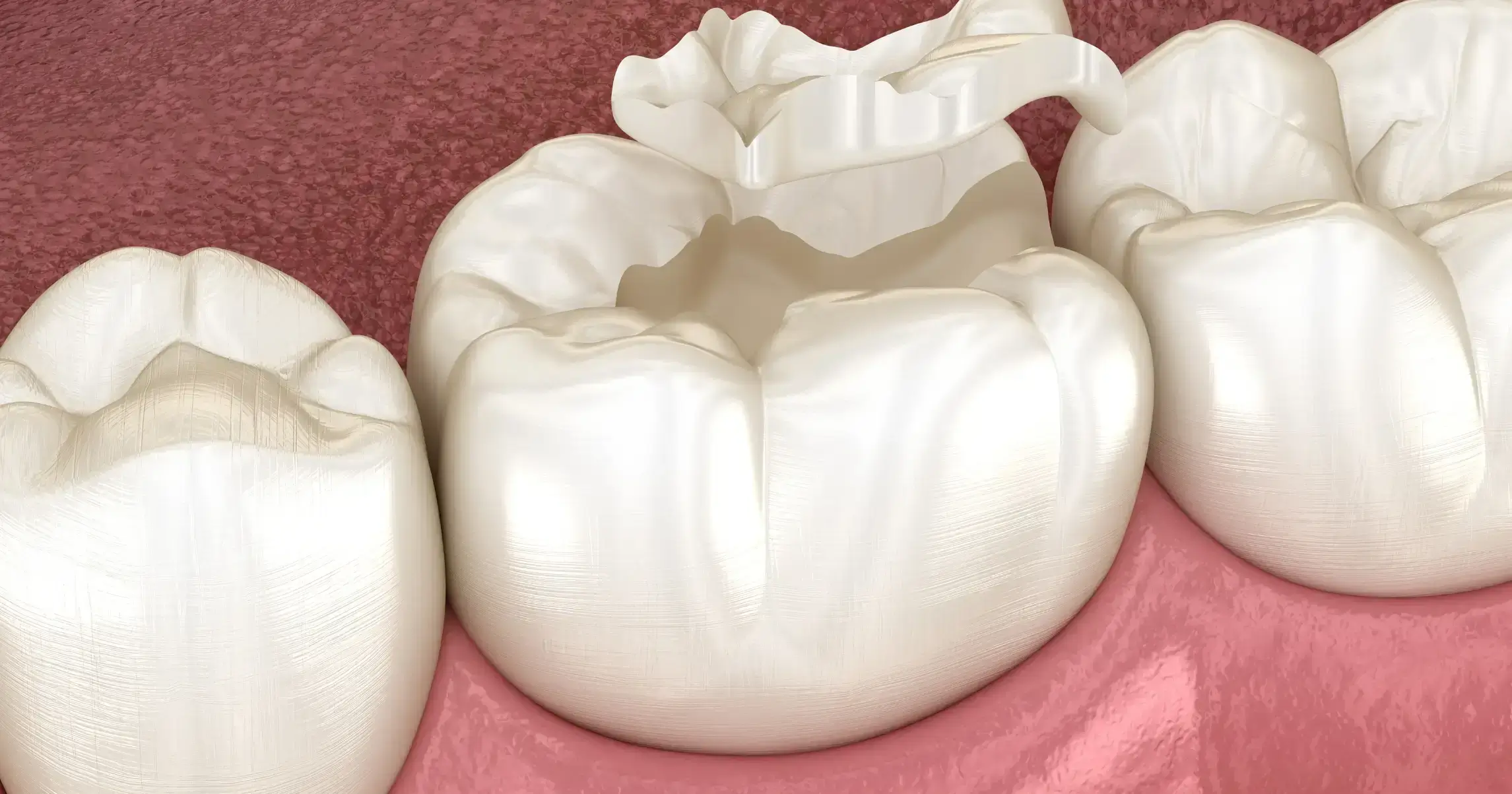 protect your teeth from cavities with dental sealants
