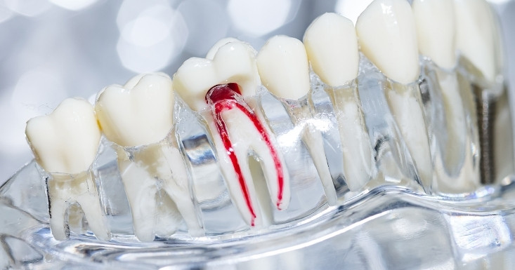 a comprehensive guide on root canal treatment