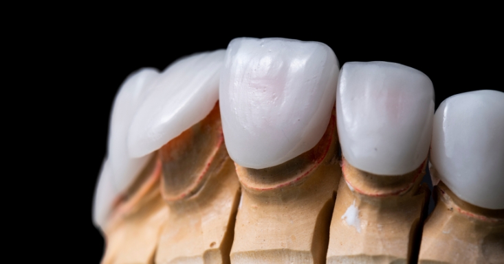 the transformative power of porcelain veneers