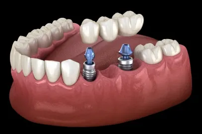 Your implant process, step by step – Riverpark Dental of Howell