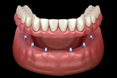 Cost, insurance and financing – Riverpark Dental of Howell