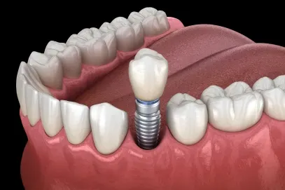 Why implants instead of a bridge or a regular denture – Riverpark Dental of Howell