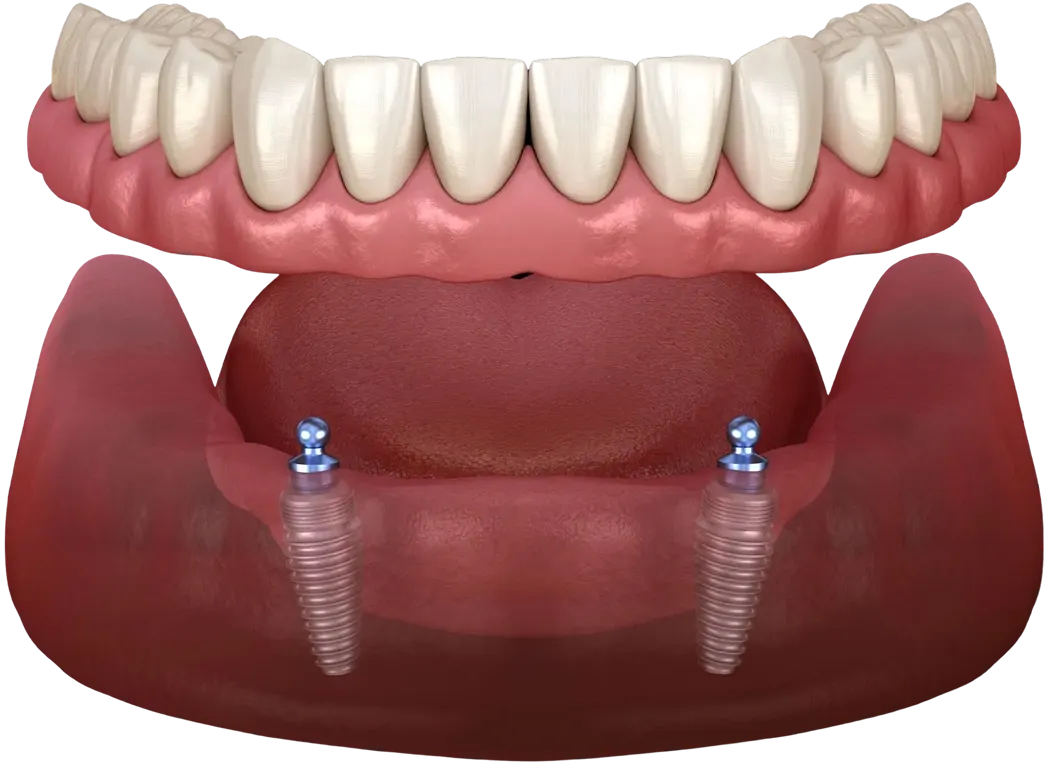 How many implants you'll need – Riverpark Dental of Howell