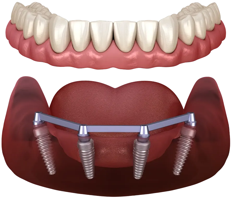 Who does the work, and what it costs – Riverpark Dental of Howell