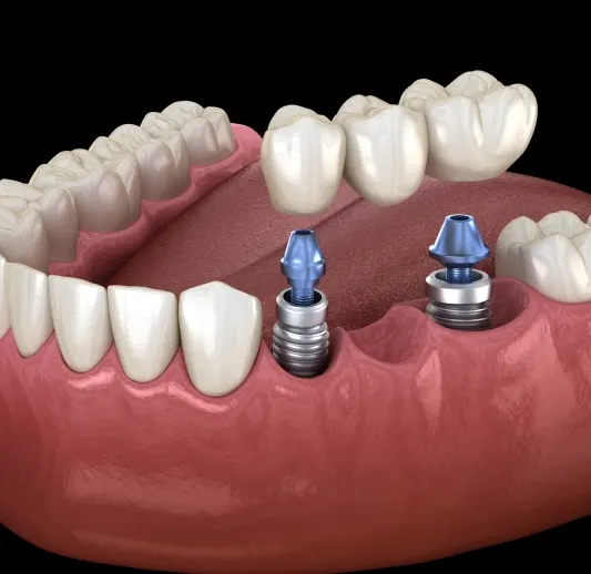 Single Tooth Implant Howell – implant crown replacing a missing tooth at Riverpark Dental of Howell