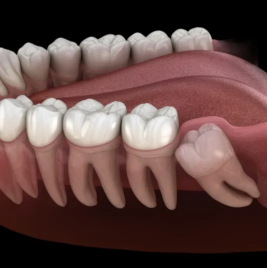Wisdom Teeth Removal Howell – dentist reviewing a wisdom tooth X-ray with a patient at Riverpark Dental of Howell