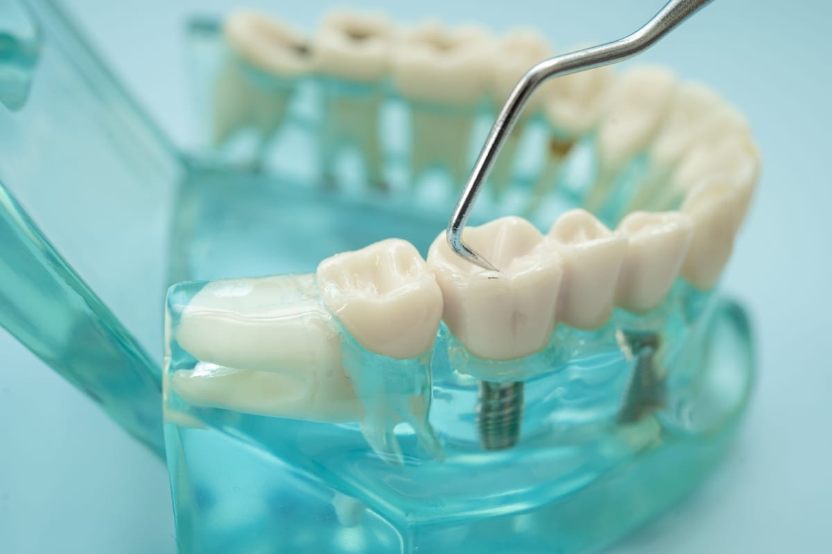 Dental Bridges in Farmingdale